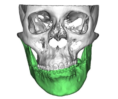 institut-ortodoncia_tratamientos_cirugia-ortognatica_asimetrias-faciales