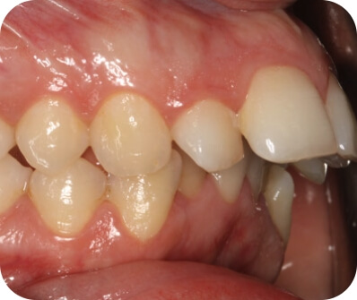 institut-ortodoncia_tratamientos_cirugia-ortognatica_clase-2