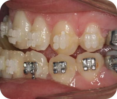 institut-ortodoncia_tratamientos_cirugia-ortognatica_clase-3